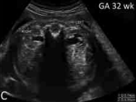 Εμβρυο 32 εβδομάδων το νεφρικό παρέγχυμα , παρουσιάζει διάταση καλύκων